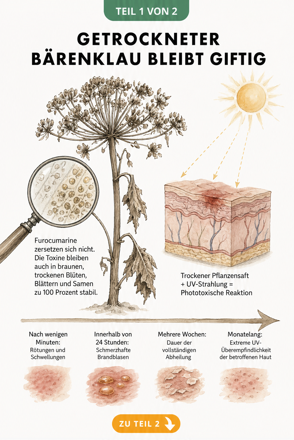 Botanische Illustration einer vertrockneten Bärenklau-Dolde mit Lupe, die Furocumarine zeigt, und einem Hautquerschnitt mit phototoxischer Reaktion durch...
