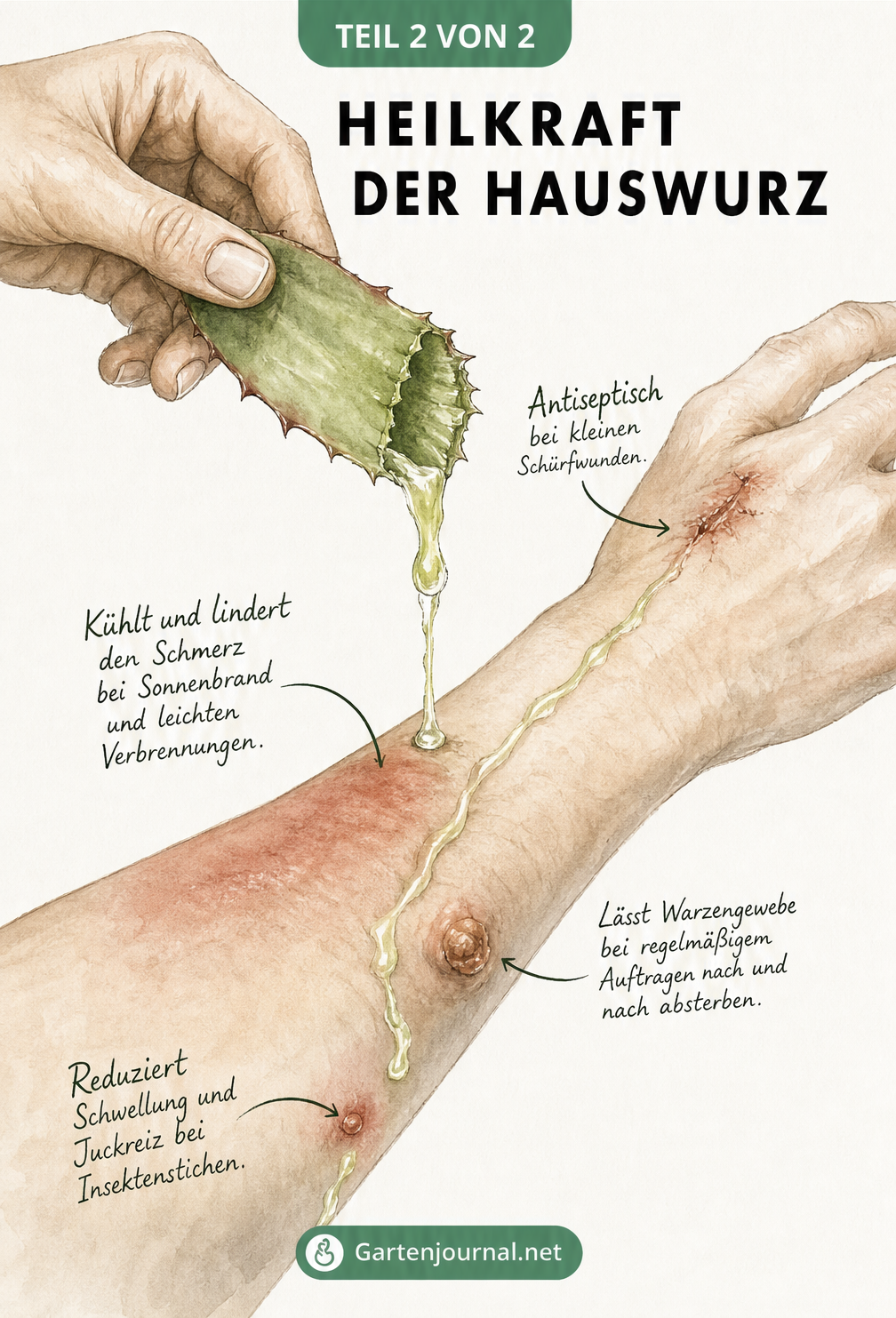 Illustration einer Hand, die ein Hauswurzblatt aufbricht, dessen Saft auf einen Unterarm tropft, mit Erklärungen zur Heilwirkung bei Wunden, Sonnenbrand und...