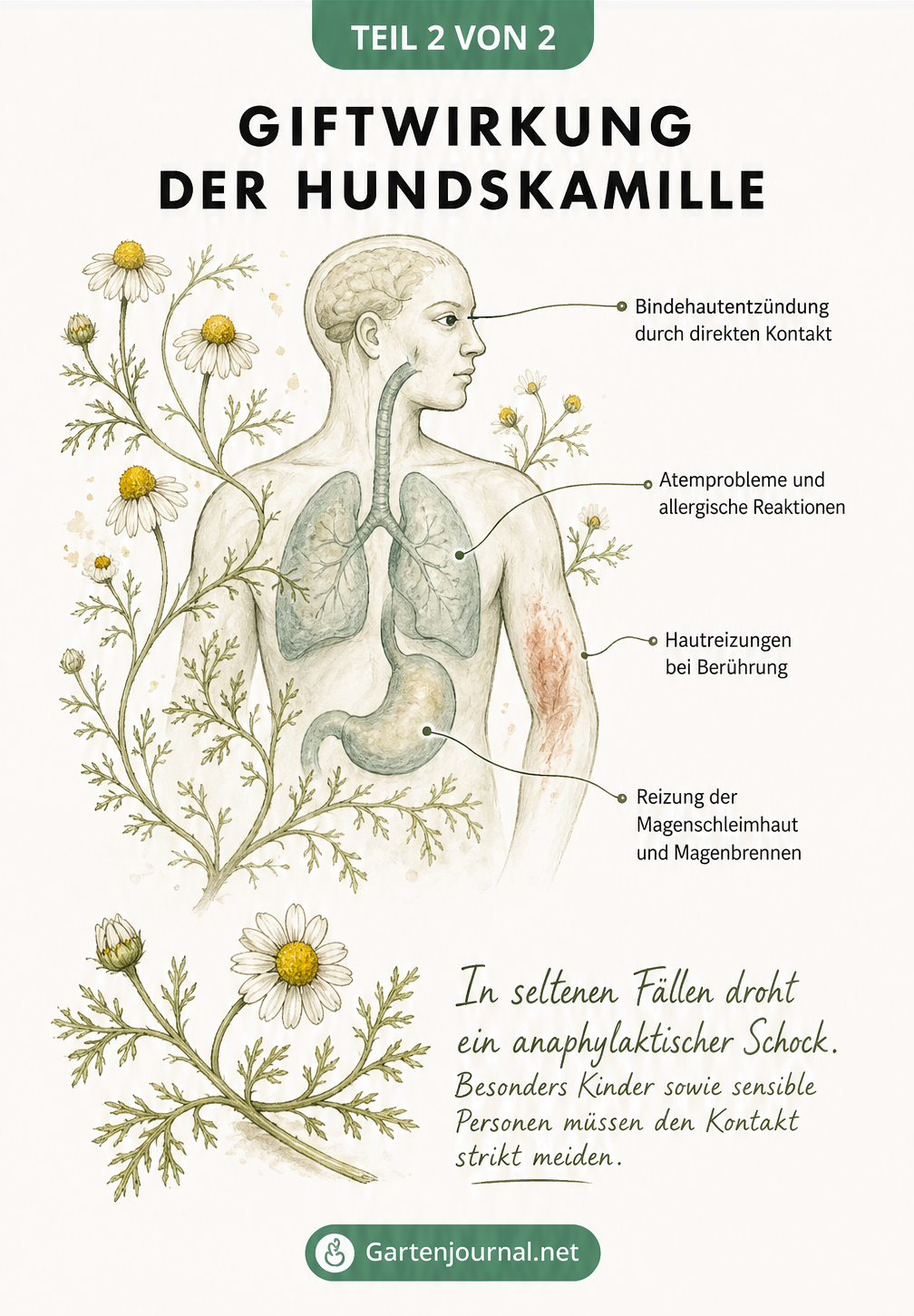 Illustration eines menschlichen Oberkörpers mit Symptomen der Giftwirkung durch Hundskamille