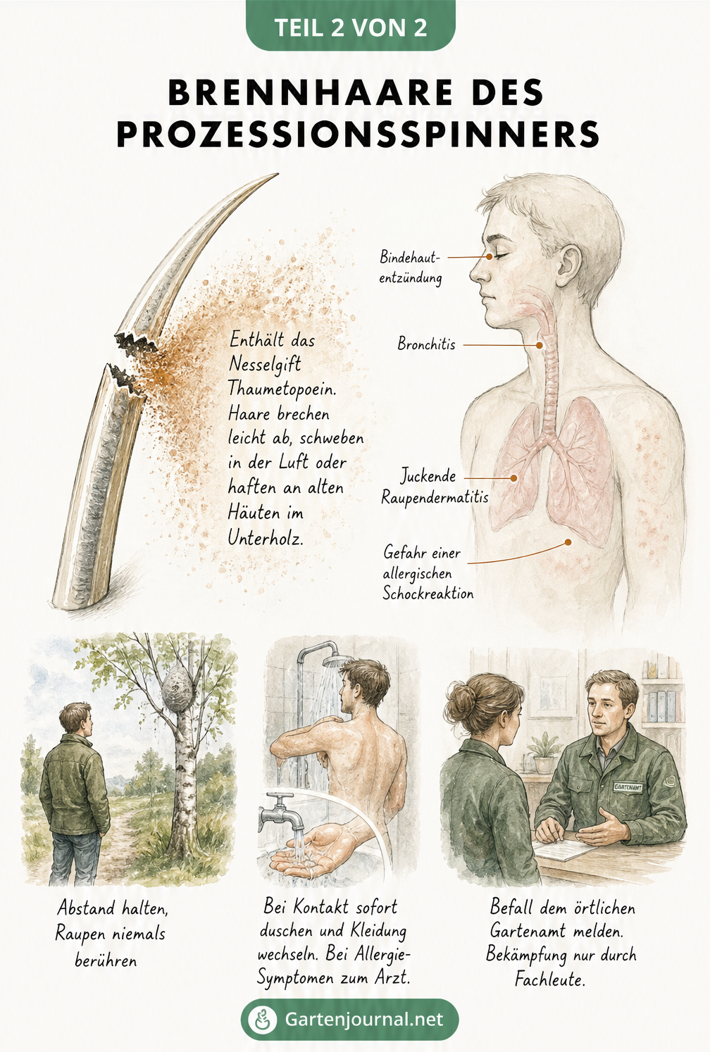 Medizinische Illustration eines Brennhaars des Prozessionsspinners mit austretendem Nesselgift und den Auswirkungen auf den menschlichen Körper